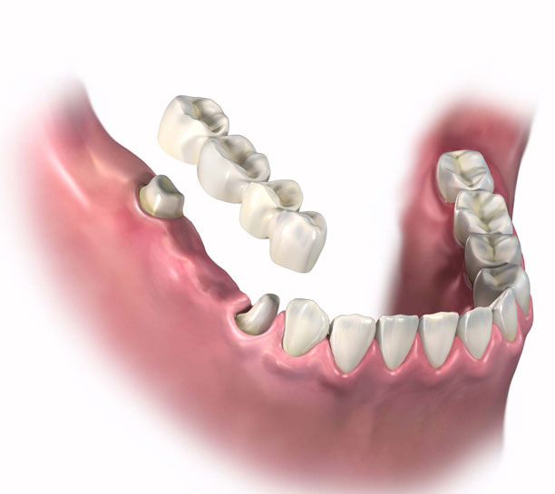 Clinical Concerns and Common Misconceptions Regarding Zirconia Restorations eBook Thumbnail