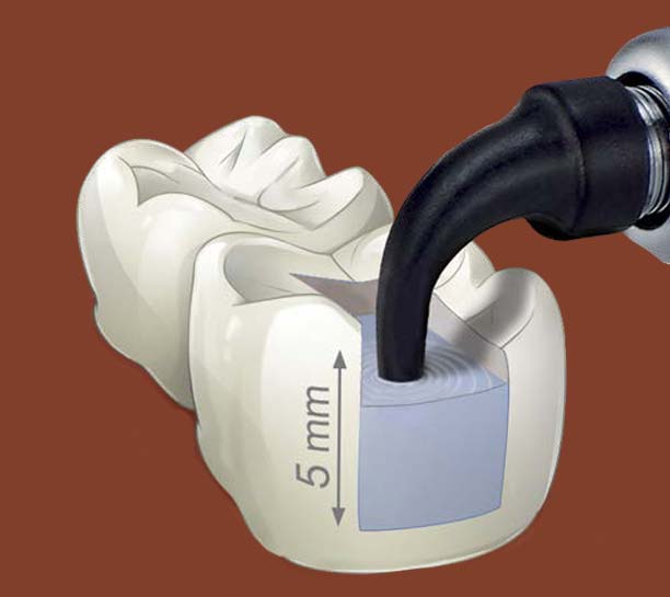 Predictable, Profitable, and Efficient Posterior Composite Restorations eBook Thumbnail