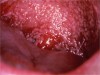 Figure 1  Candidosis: Note the widespread distribution of raised, white patches on the hard and soft palate and uvula in this patient undergoing chemotherapy for cancer. This is also called pseudomembranous candidosis as the white patches will wipe away.