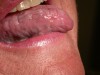 Figure 2  Chronic graft-versus-host disease: This patient had a bone marrow transplant approximately 6 years prior for the treatment of lymphoma. Her tongue shows a pebbly surface and feels firm and fibrotic.