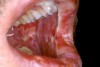 Figure 3  Mucositis: This patient has severe erythema and ulcerations throughout the oral cavity and is unable to eat, drink, or speak.