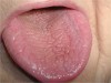 Figure 4  Xerostomia: This patient has had significant radiation to the posterior part of the tongue and oropharynx, causing the parotid glands to be fibrotic and stop functioning. There is very little saliva, and the surface appears to have many fissures.