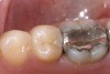 Figure 4  Defective margins. Mandibular first molar with an amalgam restoration with defective margins.