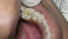 Figure 5  Clinical applications of RBCs for posterior restorations: occlusal caries restored with silorane-based RBC