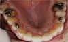 Figure  3  Severe dental erosion and attrition in a GERD patient.