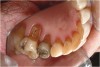 Figure  6  Erosion and abrasion in a xerostomic patient with Sjögren’s syndrome.