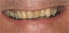 Figure  11  Loss of tooth enamel and translucency, resulting in yellowing of teeth.