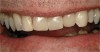 Figure 12  Adhesive dentistry with resin-based composite.