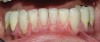 Figure  16  Prevention of tooth surface loss by a resin-based composite restoration.
