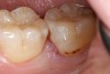 Figure 5  Defective margins. Mandibular second molar with a Class II composite resin with a defective facial–gingival margin.