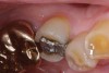 Figure 6  Restoration fracture. Fractured isthmus of an amalgam restoration.