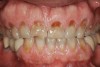 Figure 1   Classic presentation of the bruxism triad. Lateral wear pattern, generalized buccal tooth loss from erosion and abrasion, and history of sleep disruption.