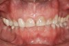 Figure 2   Asymmetric tooth wear in a bruxism triad patient as a result of friction from bruxing, poor salivary lubrication as a byproduct of medication, and roughened surfaces created as a result of erosive reflux.