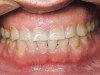 Figure 8   Young adult with signs and symptoms of the bruxism triad: Lateral tooth wear, erosive and abrasive damage to the teeth, and a history of moderate apnea.
