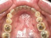 Figure 9   Extensive erosive wear. Airway improvement can reduce GERD and GERD resolution can reduce sleep bruxism.