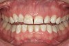 Figure 14  Bruxism triad in a young adult. The pathologic wear, once limited to the anterior teeth, is beginning to appear on the posteriors as guidance is lost. Patient reported sleep issues that became exacerbated with pregnancy. GERD was intermittent until pregnancy then it increased.