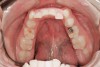 Figure 15  Patient demonstrates wear on deciduous molars increasing the risk of bruxing as an adult. Another explanation may be the triad. Constricted dental arch, crowded lower anteriors, and a deep bite with a lifetime of airway-related issues. GERD history coupled with erosive wear on teeth.