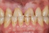 Figure 21   Mature patient with the bruxism triad. Lifetime history of bruxism, snoring, intermittent poor sleep, and GERD symptoms. Sleep study results indicate severe apnea.