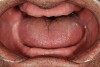 Figure 23  Retracted tongue position in edentulous patients limits the available airway. Wearing their dentures at night may allow for a more favorable airway.