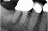 (1.) A 74-year-old male presented with an acute apical abscess associated with tooth No. 30. The pre-operative periapical x-ray revealed evidence of apical pathology.