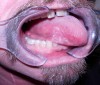 Fig 1. Squamous cell carcinoma, right lateral tongue. (Photograph courtesy of Darren Cox, DDS, MBA, University of the Pacific)