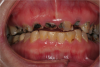 Fig 2. Rampant caries and nonrestorable root tips.