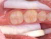 Figure 4  Etched occlusal surface.