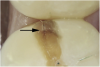 Fig 1. Decalcification in enamel along a crack line (arrow) and caries at the dentin-enamel junction of a mandibular left first molar (disto-occlusal view).