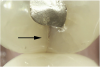 Fig 2. Asymptomatic enamel marginal ridge crack (arrow) of a mandibular left second molar with enamel ditching viewed under magnification by intraoral photography (mesio-occlusal view).