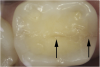 Fig 4. Subtle asymptomatic occlusal crack (arrow) of a mandibular right second molar (occlusal view).