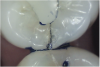 Fig 6. Methylene blue dye staining revealing asymptomatic enamel marginal ridge crack of a maxillary left first molar (mesio-occlusal view).