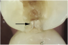Fig 7. Existing restoration removal and crack fissurotomy revealing enamel crack (arrow) and caries in tooth shown in Fig 6.