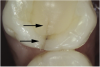 Fig 10. Stained asymptomatic enamel marginal ridge crack (arrows) of a maxillary right first molar extending to the existing restoration (mesio-occlusal view).