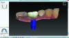 Fig 7. Open STL system design software for screw-retained crown.