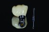 Fig 12. Screw-retained angulated screw-channel full-zirconia crown.