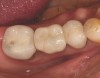 Fig 13. Screw-retained implant crown replacing missing first molar, occlusal view.