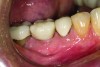 Fig 14. Screw-retained implant crown replacing missing first molar, buccal view.