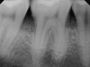 Fig 2. Periapical radiograph showing presence of distal bone loss and calculus.