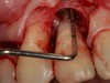 Fig 8. Flap elevation confirms circumferential bone loss.