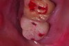 Fig 1. Occlusal contacts on the provisional.