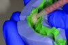 Fig 3 and Fig 4. Fabrication of the provisional; injecting the material.