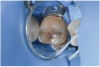 Fig 3. Clinical appearance with no perceptible “stick” with an explorer on a patient with tetracycline-stained teeth.