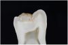 Fig 9. ICDAS code 1: Indicated groove on Fig 8 sectioned to show enamel decalcification in outer half of enamel. If caries risk assessment indicates disease, a sealant or preventive resin restoration could halt its progression.