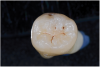 Fig 10. ICDAS code 2: Decalcified enamel is visible when wet and is notably wider than the natural fissure.