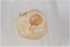 Fig 16. ICDAS code 6: Carious dentin visible in more than half of the occlusal table.