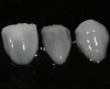 Fig 7. CL-IIa veneers with minimal incisal porcelain layering.