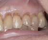 (Figure 2.) Gingival recession with exposed root surfaces are susceptible to dentinal hypersensitivity non-carious cervical lesions on the facial surfaces of maxillary teeth with symptoms of dentin hypersensitivity and in need of restorations.