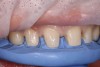 (7.) Preparation guide in the mouth showing a uniform incisal reduction.