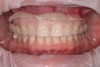 (13.) Depth cuts made in three facial planes, extending from the distofacial to the mesiofacial, in order to visualize the proper reduction.