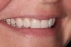 (16.) The postoperative right smile.